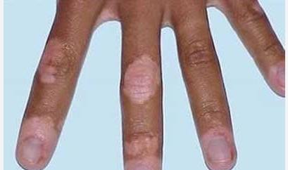 局限性白癜風用什么藥物治療?