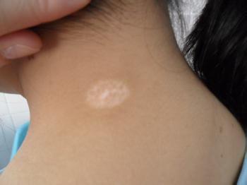 白癜風用藥一定要注意的事項有哪些