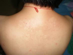 女性白癜風患者不宜采用哪些治療方法