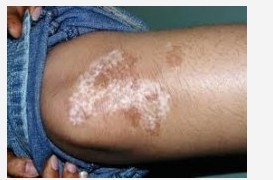 邯鄲白癜風初期如何治療才能達到較為理想的效果?