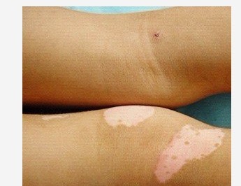 治療小孩子肢端型白癜風河北哪家醫(yī)院比較好?