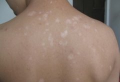 成人白癜風的皮膚白斑擴散階段該怎么治療?