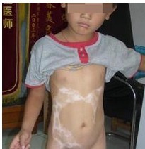 兒童白癜風出現(xiàn)癥狀后一般采用哪種常規(guī)治療?