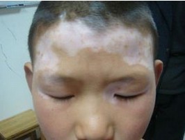 治療頭部白癜風適合用什么辦法?