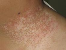 白癜風是不是真的能治好?