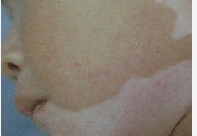 小孩臉上的小片白癜風(fēng)是不是可以用藍(lán)氧技術(shù)治療?