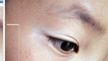 目前白癜風治療方法療效好的有哪幾種?