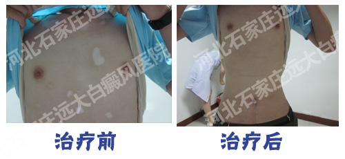 白癜風(fēng)長在胸前容易治療嗎