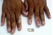 手部白癜風能做黑色素移植嗎