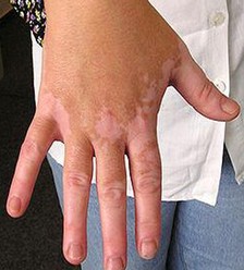 手部白癜風會有什么發病特點?