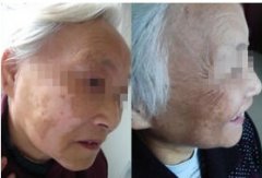 早期如何治療老年白癜風