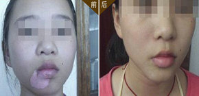 臉部白癜風的治療方法哪種有效