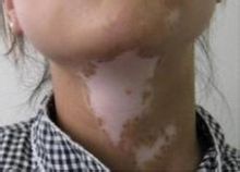 頸部白癜風(fēng)有能治好的方法嗎