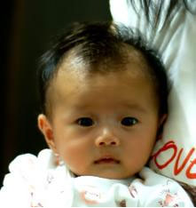 嬰幼兒遺傳而來的白癜風(fēng)治療需要多長時間