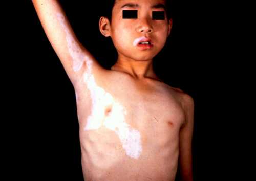 胸部白癜風早期有哪些癥狀及治療方法