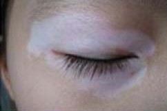 眼睛周圍白癜風怎么治療