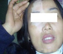 治療臉上的白癜風(fēng)什么方法比較好?
