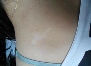 兒童頸部白癜風(fēng)白斑怎么治療