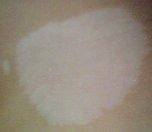 治療局限型白癜風的方法