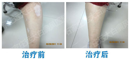 腿部白癜風該怎么治療?