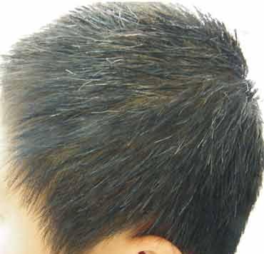 頭部白癜風的治療方法