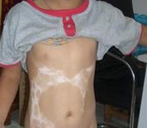 怎樣治療穩定期的青少年白癜風