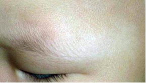 白斑處體毛有變白怎么治