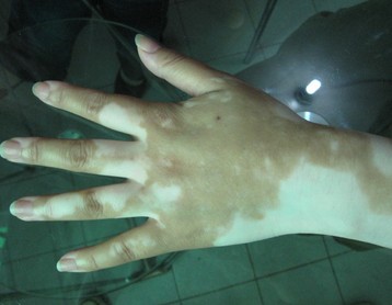 手上白癜風能治好嗎