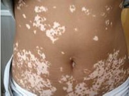 白癜風治療誤區