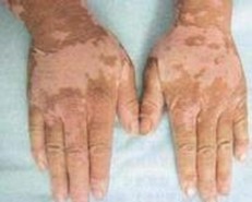 &beta;-胡蘿卜素有益白癜風治療嗎