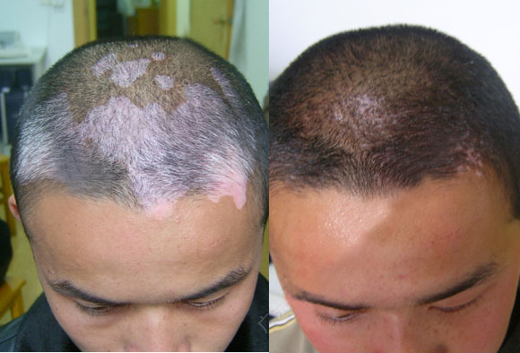 石家莊白癜風的治療攻略