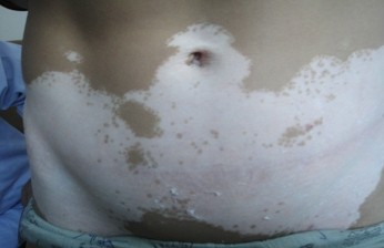 白癜風患者能飲酒嗎