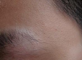 先天性白癜風怎么治療