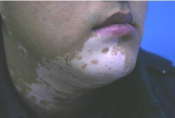 治療白斑病時光療過度怎么辦？