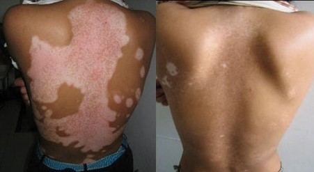 白癜風治療的鞏固方法有哪些？