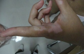 如果白癜風治療中途放棄會有哪些后果呢？