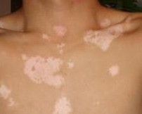 黑色素移植治療白癜風效果怎么樣？