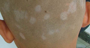 頭皮上得了白癜風怎么治療更好呢？