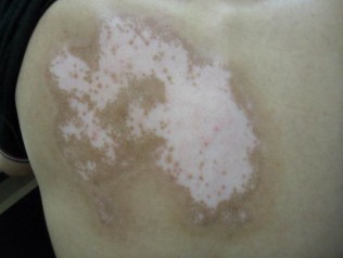 白癜風不治療會有什么后果呢？