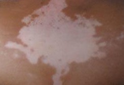 要從根本上治好白癜風要怎樣做呢？