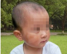 兒童白癜風患者選擇哪種治療效果更好呢?