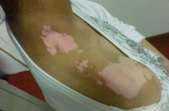 什么方法對白癜風(fēng)治療有好處?