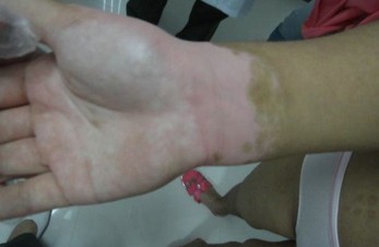 要重視初期白癜風該如何做？