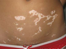 白癜風(fēng)患者常見的心理治療措施有哪些呢？