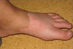 足療也可以促進白癜風的治療嗎?