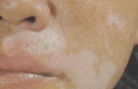 穩(wěn)定期白癜風(fēng)的治療方法