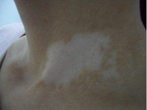 <a href=http://m.xvxgx.cn/ target=_blank class=infotextkey>石家莊白癜風醫院</a>醫師解說白癜風治療三步走