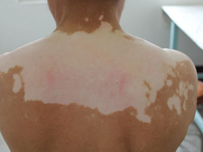 怎樣找對白癜風治療的關鍵點?