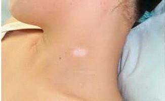 哪些食物有益于白癜風(fēng)治療