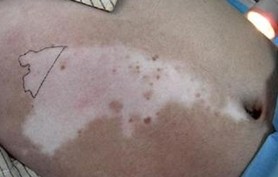 避免白癜風復發 石家莊治療白癜風好醫院有妙招